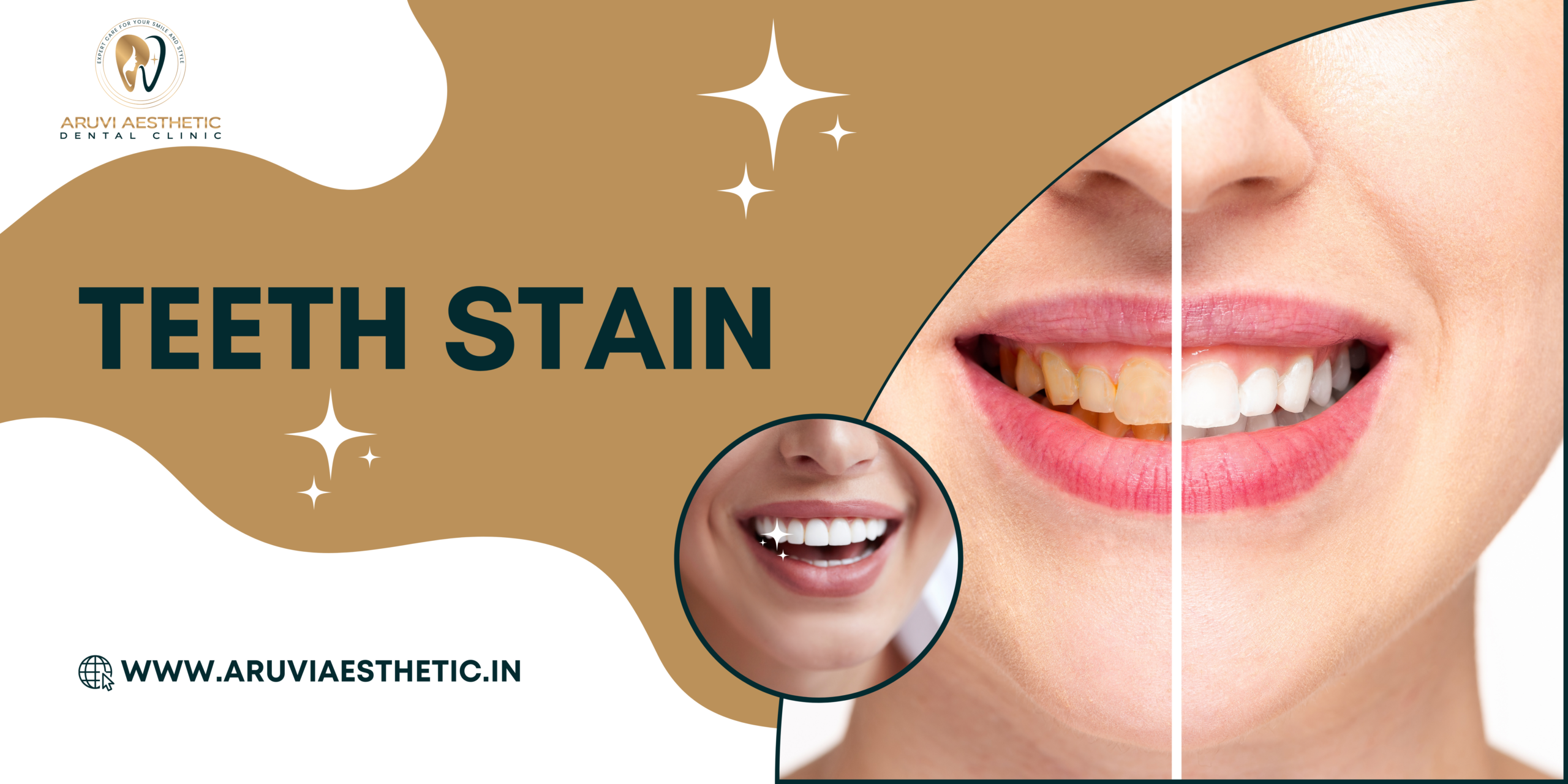 Before and after comparison of teeth staining, showing yellowed teeth on one side and bright white teeth on the other.